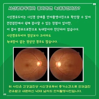 녹내장 진단 검사 비용 안압 검사주기 관리법_6