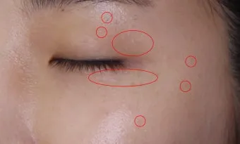 비립종 생기는 이유 비립종 없애는 방법 피부 관리법_21