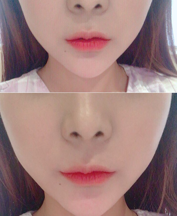 입술확대수술