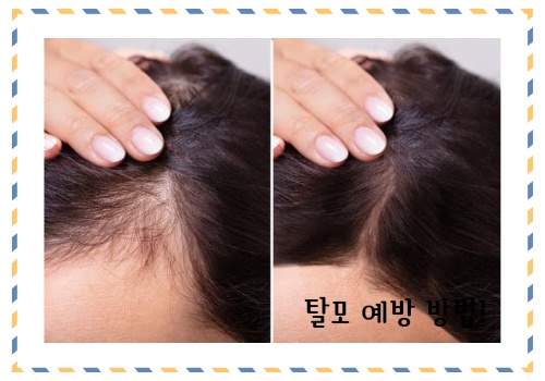 탈모 예방 방법 알아보고 예방