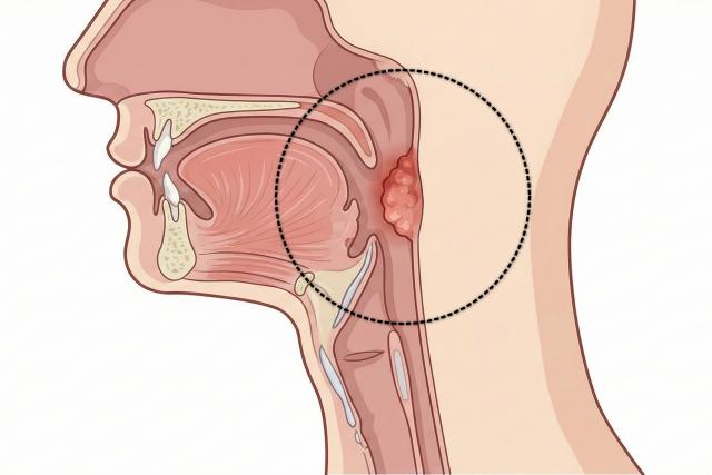 침 삼킬때 목 아픈 이유 인후통 원인 인후암
