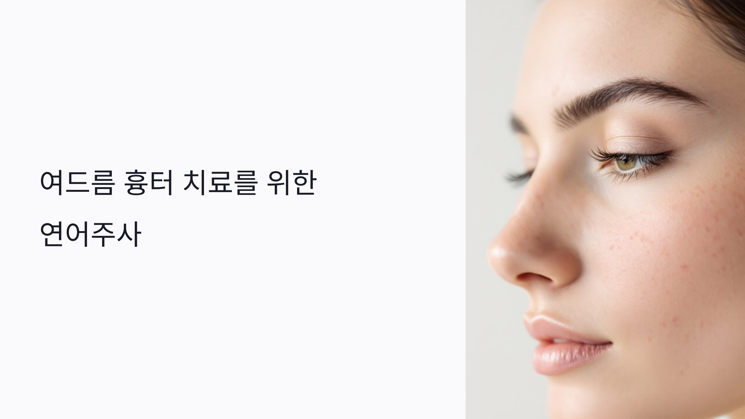 여드름 흉터 치료에 연어주사가 효과적인 이유와 시술법 총정리