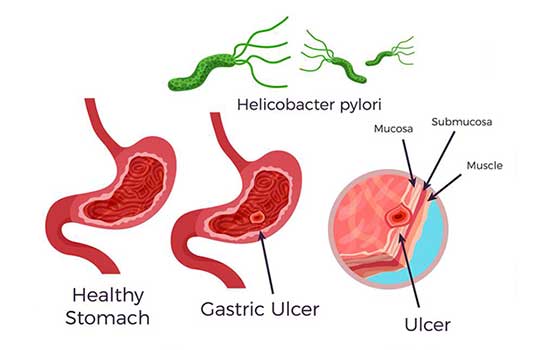 위궤양-십이지장-궤양-원인