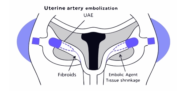 자궁근종 치료 과정