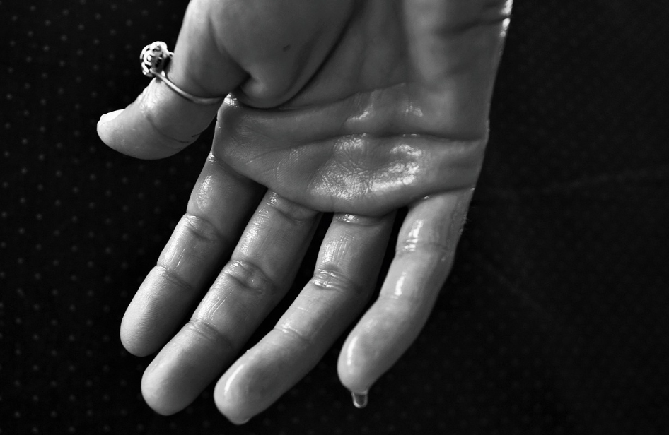 다한증환자 손의 모습