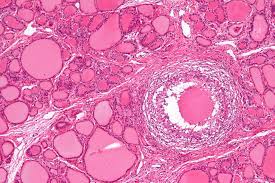 갑상선 기능 저하증