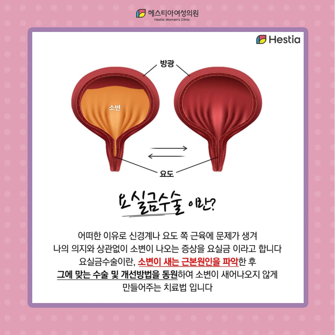 요실금수술 이란?