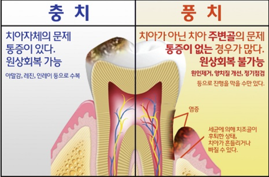 풍치와-충치의-차이점