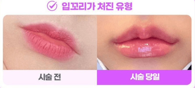 입술필러의 모든 것