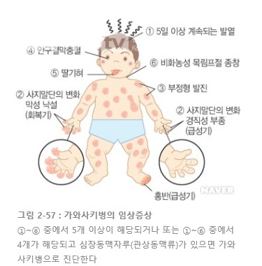 가와사키병-증상