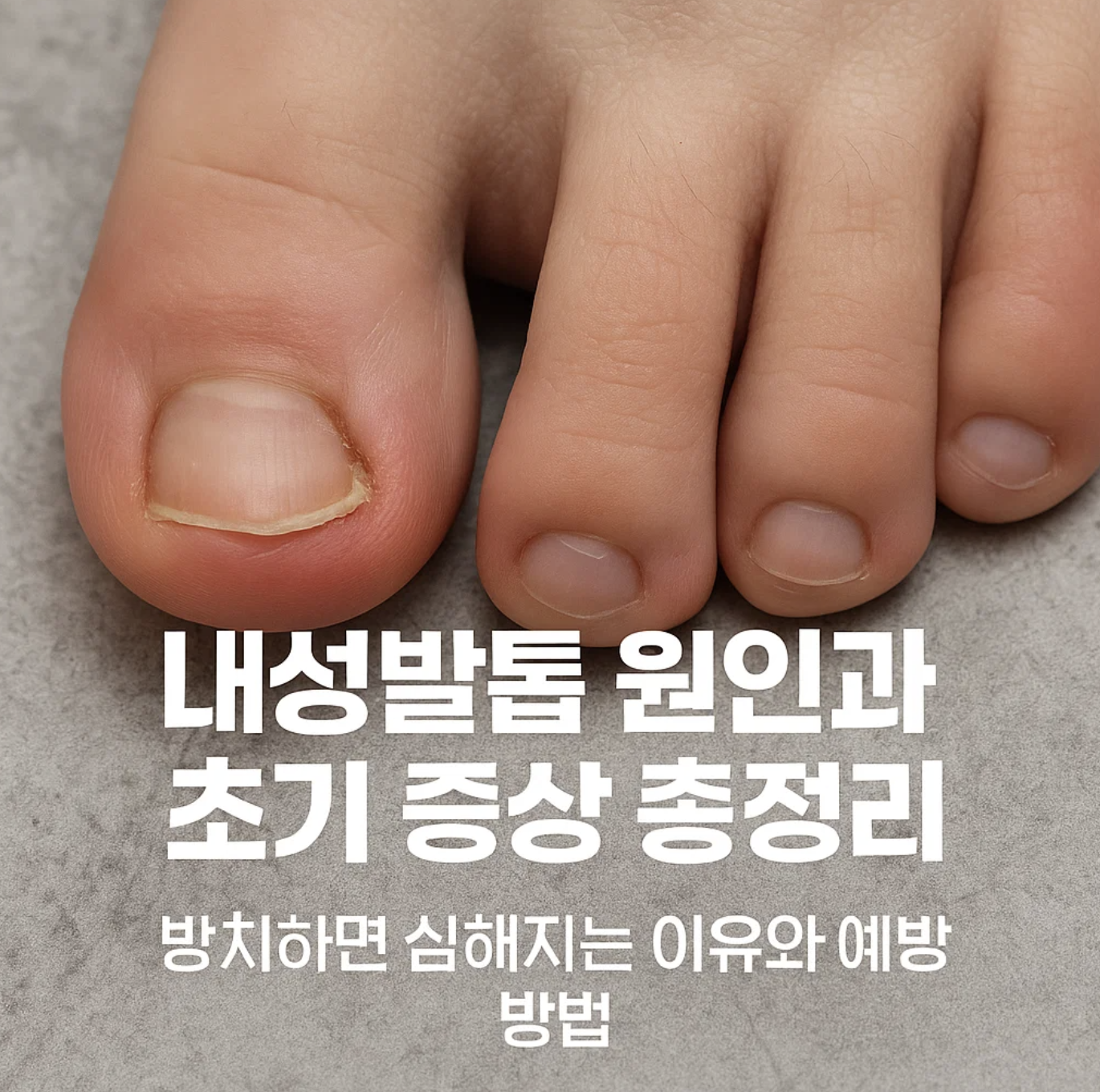 내성발톱 원인과 초기 증상 총정리, 방치하면 심해지는 이유와 예방 방법