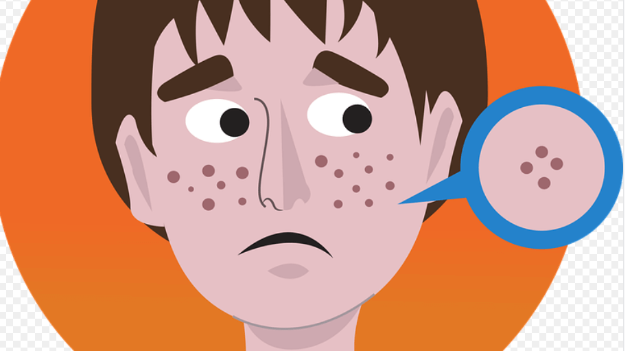 여드름이 나 있는 모습 - 3