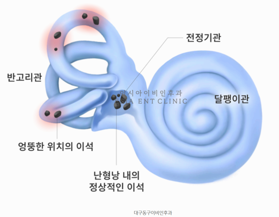 이석증 증상 총정리 어지럼증 원인부터 치료·예방법까지