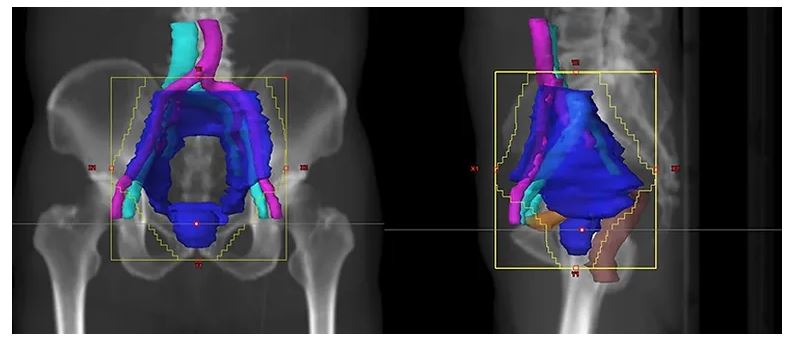 전립선암 소선원치료