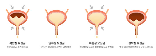 요실금원인