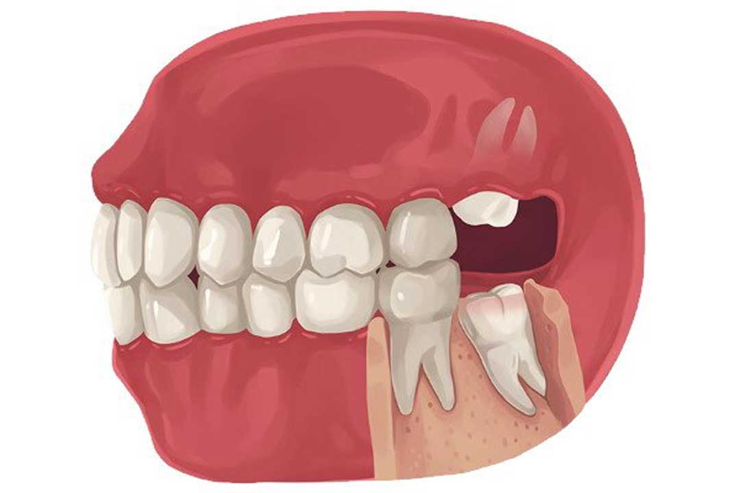 사랑니-발치-후-흡연-해도-될까-Feat-치과의사