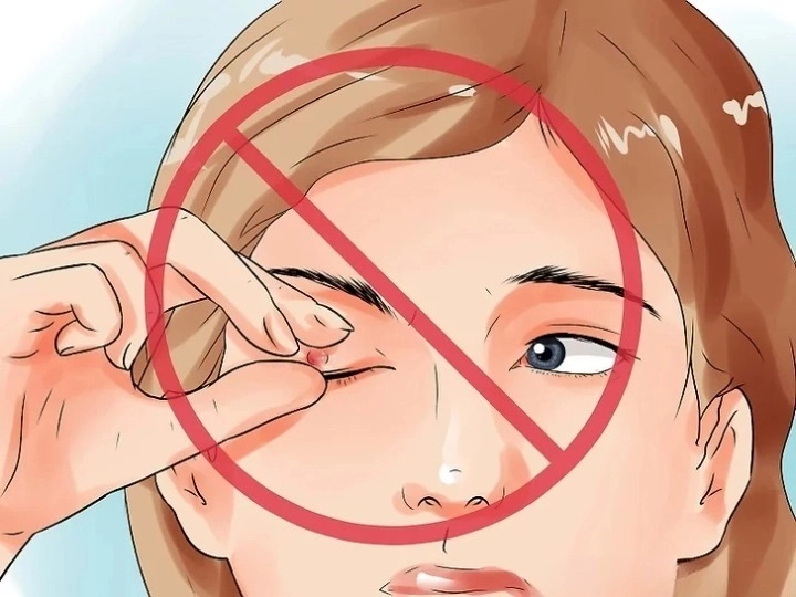 다래끼 원인 종류 빨리낫는법 눈다래끼 초기증상 치료 전염 찜질