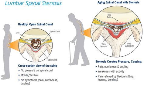 척추 협착증 원인