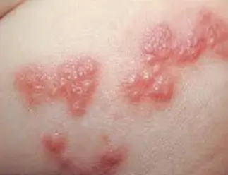 대상포진 예방접종 무료대상ㅣ초기증상 부작용