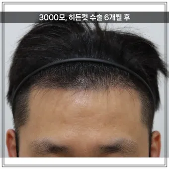 머리카락 이식 3000모 3000모낭 비용과 시술 과정_9