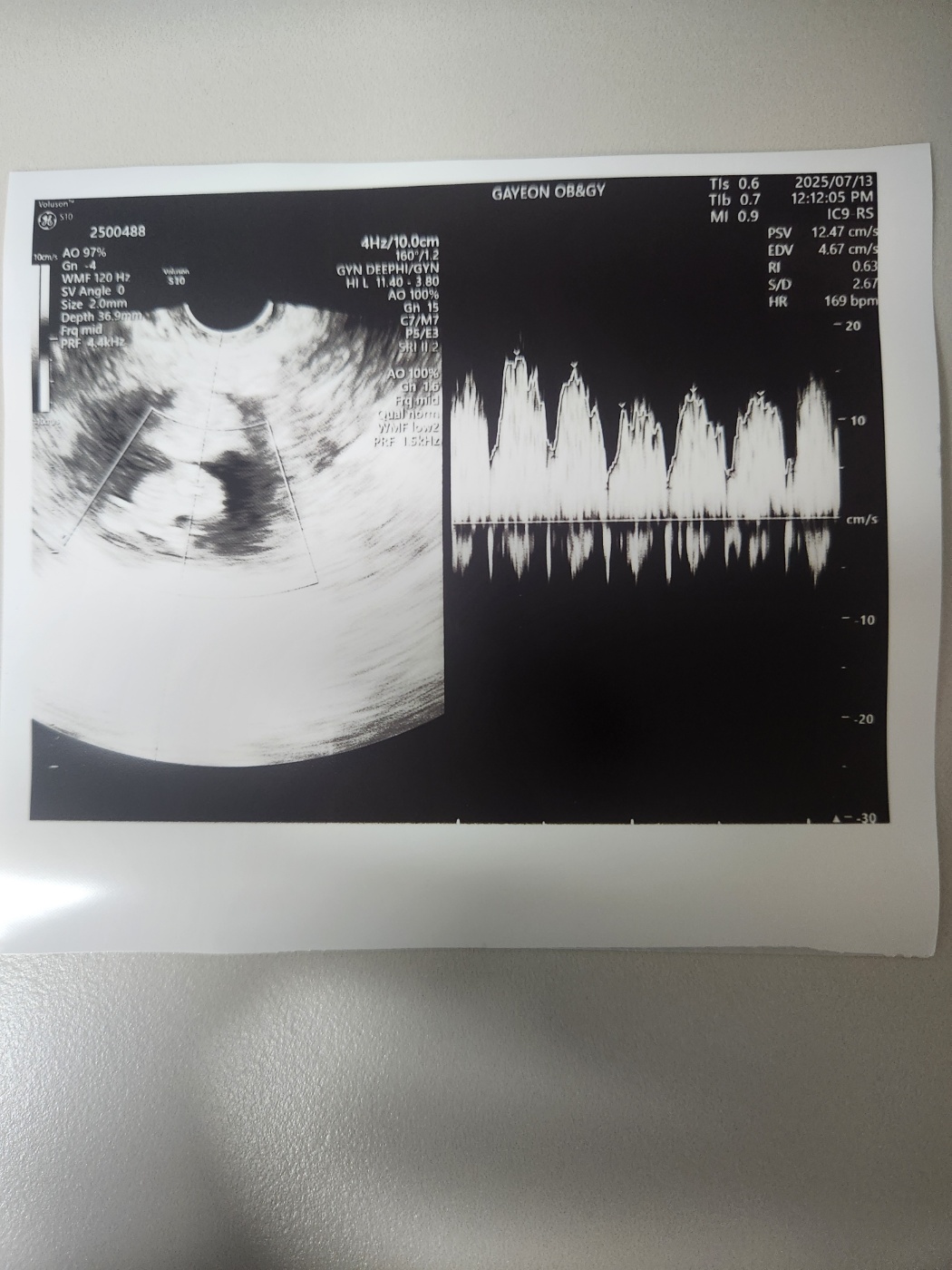 임신9주차, 9주1일차 초음파 젤리곰 난황