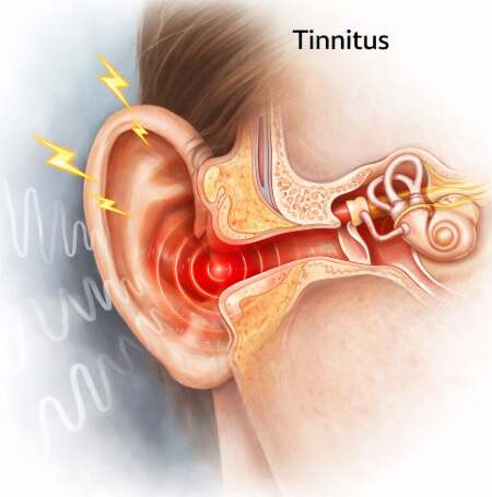 Tinnitus at dawn (Park Dong-sung's name, sleep disorder, prevention of hearing loss)