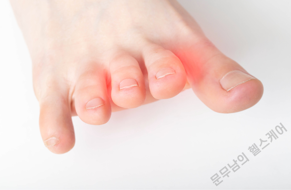 발가락 저림 증상