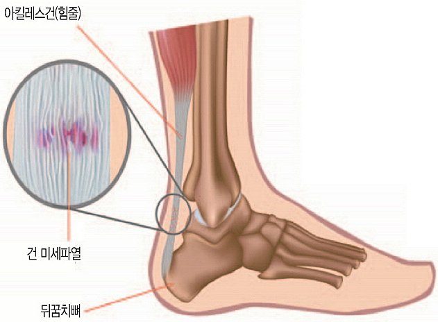 아킬레스건염 원인 - 걷는 습관