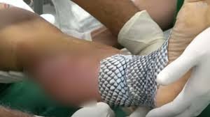 화상 물집 치료방법, 터뜨리지 말고 이렇게 치료하세요!