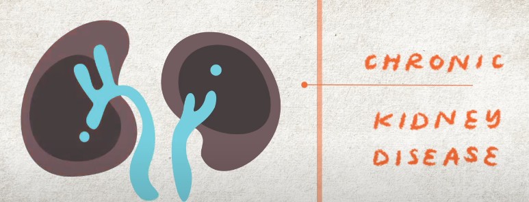 만성 콩팥병 진단기준 / 만성 콩팥병 원인과 증상/ 만성 콩팥병 검사