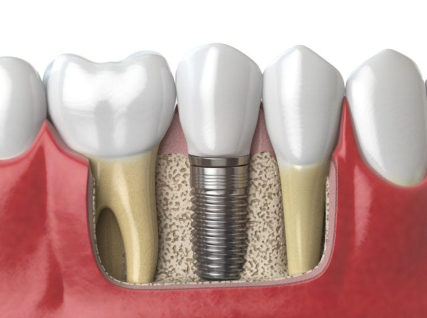 오스템 임플란트 수술비용