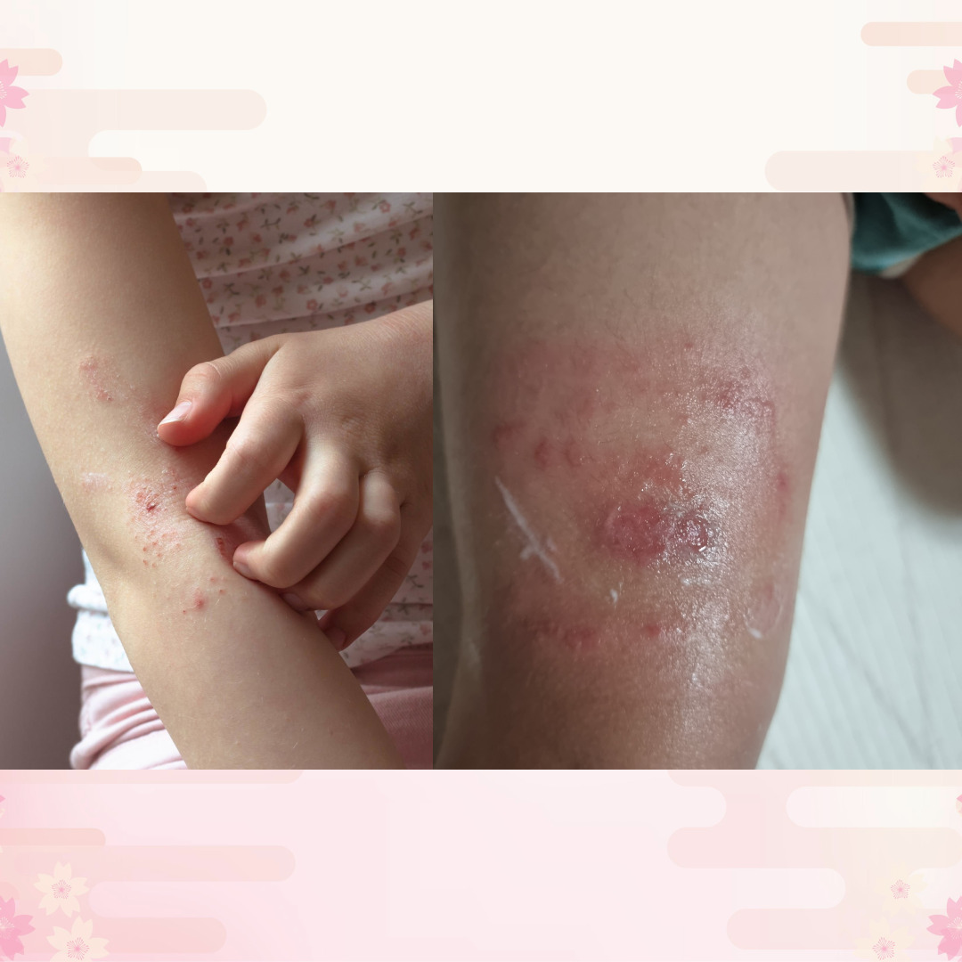 농가진 사진