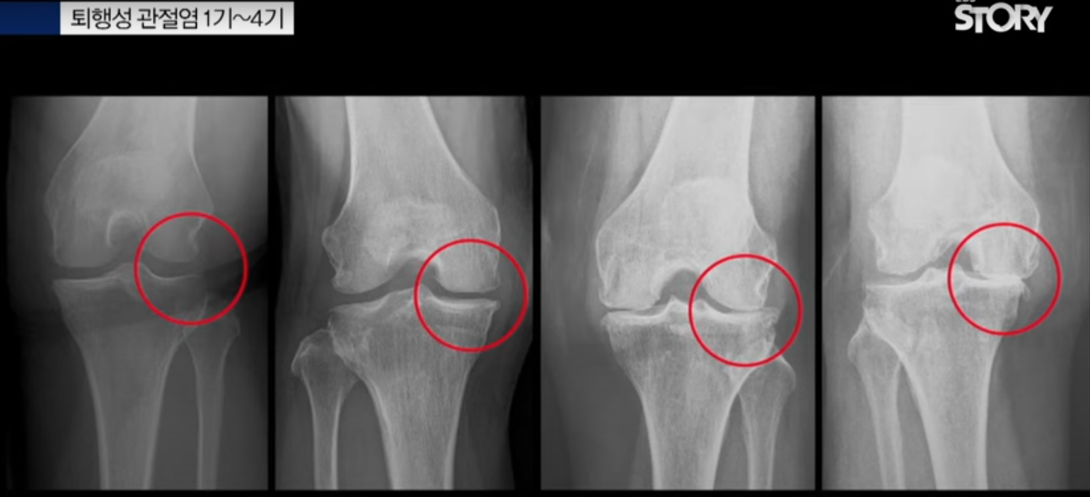 퇴행성관절염 1기~4기 사진