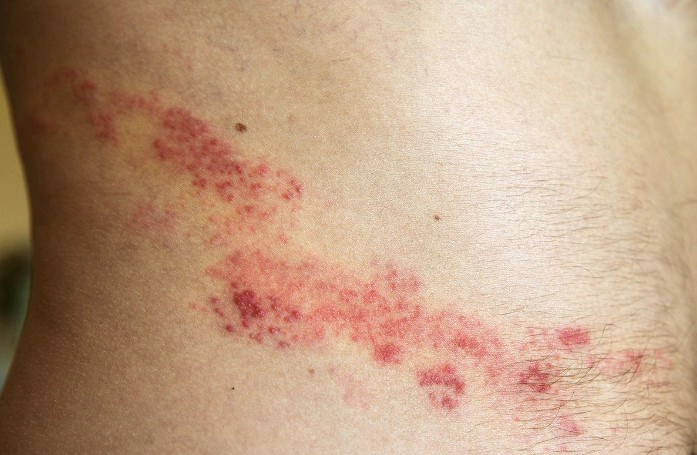 대상포진 전염성