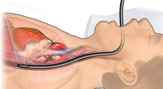 위내시경 금식시간