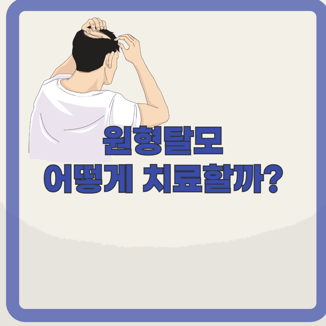 원형탈모, 스트레스가 주범? 원인과 치료 방법 알아보기