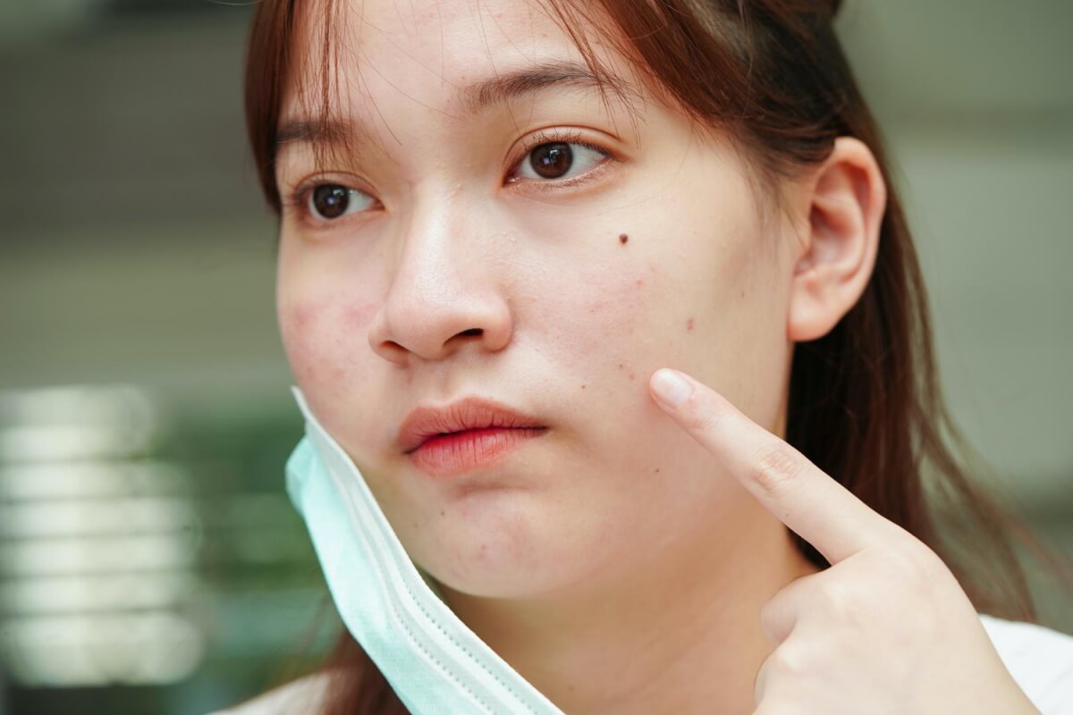 피부에-점을-제거한-여성