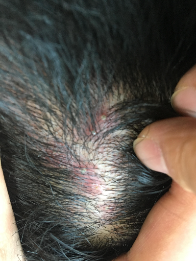 두피 뾰루지 없애는 방법 두피 관리는 이렇게