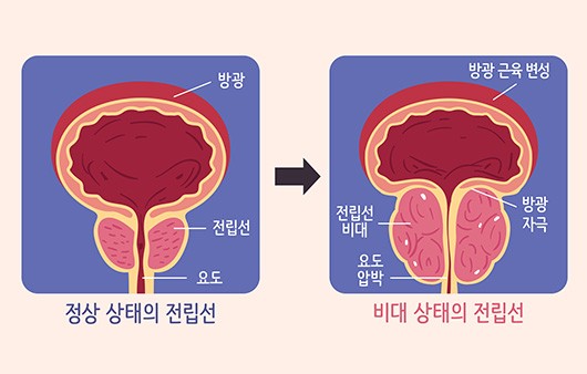 정상 상태의 전립선과 비대 상태의 전립선 비교