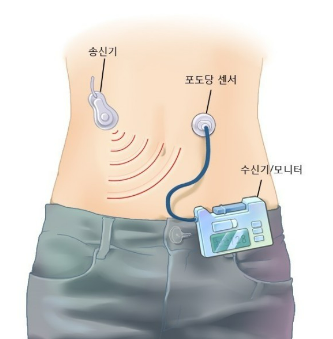 연속혈당측정기