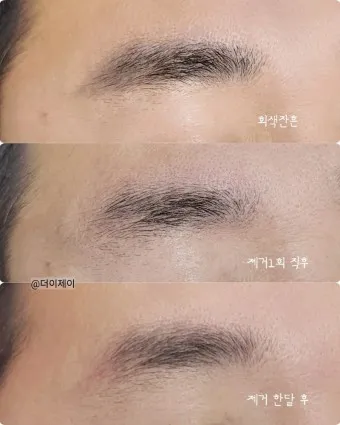 눈썹 문신 제거 방법 꿀팁_11