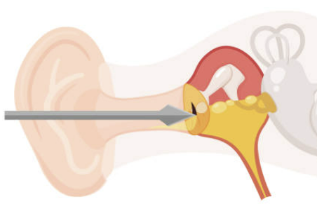 중이염 증상 치료&amp;#44; 중이염에 좋은 음식 총정리 