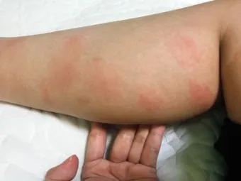 모기 물려 가려울 때 땀띠에 안티푸라민 연고 효능 부작용 사용후기_8