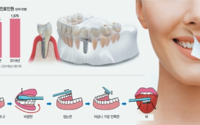 잇몸 사진