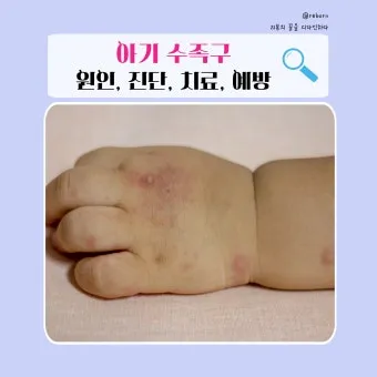 수족구 초기 증상 어른 감염 격리기간 예방 치료 완전 가이드_23