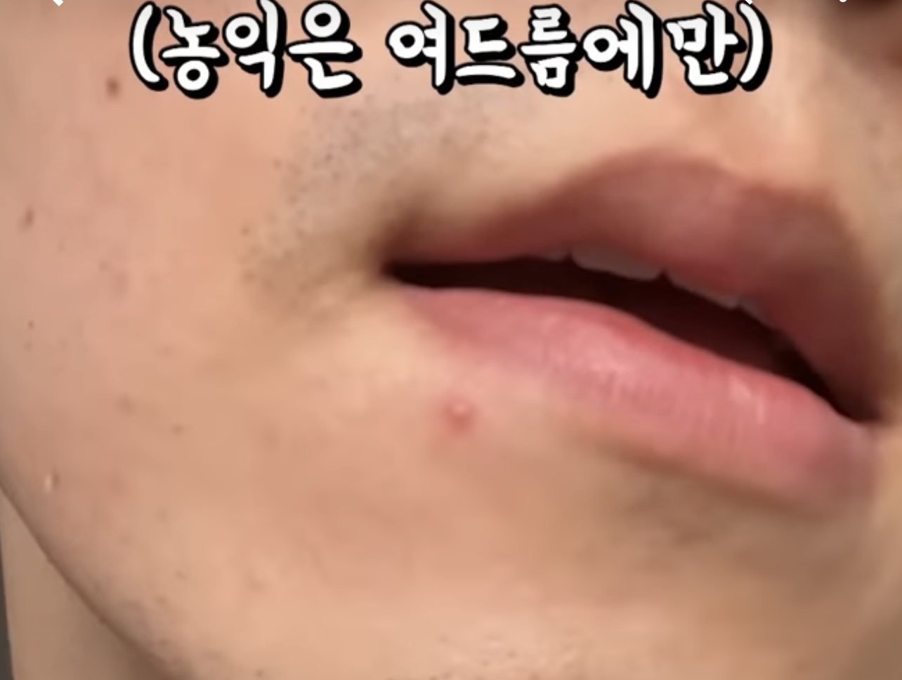 흉터 없이 여드름 짜는 방법