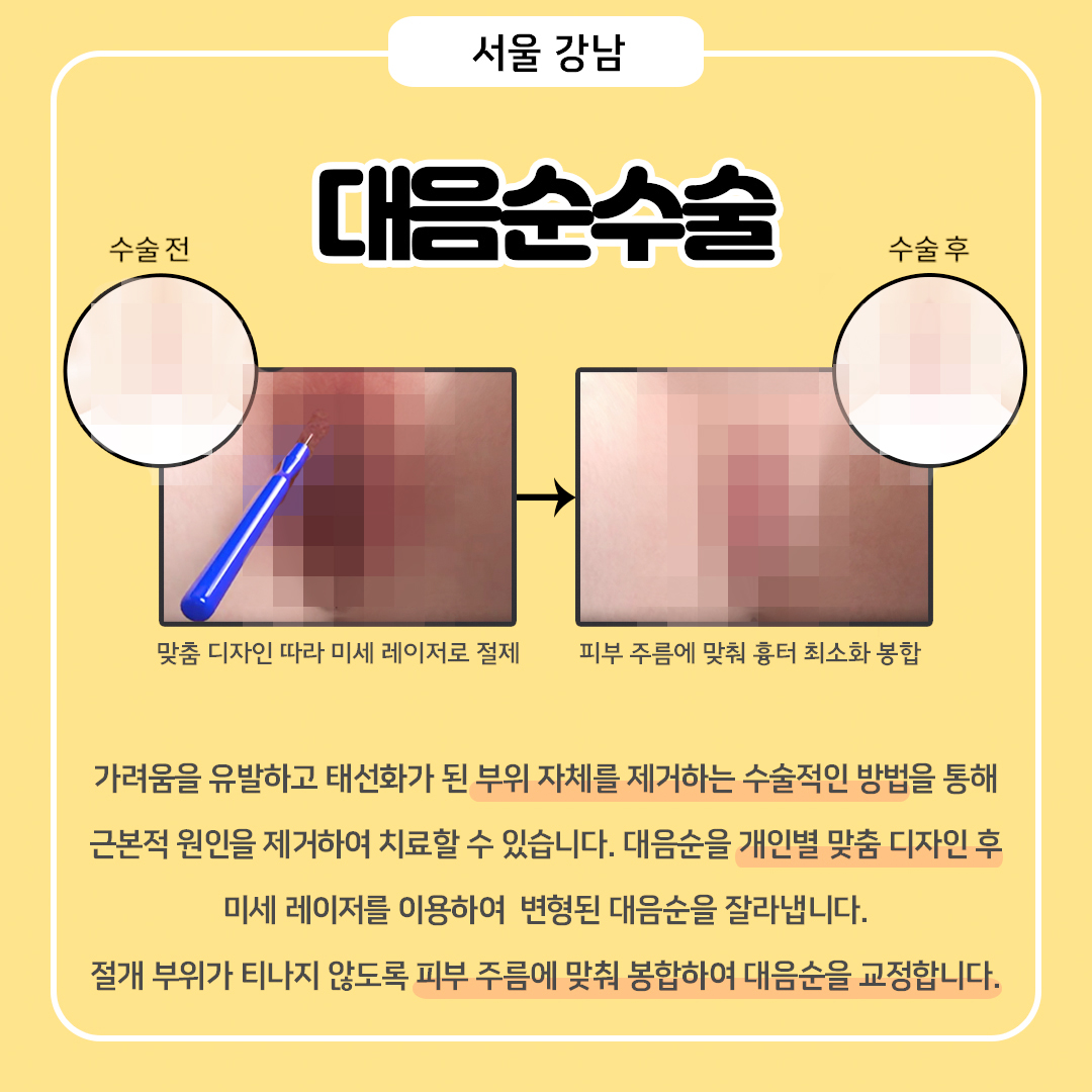대음순성형 방법은?