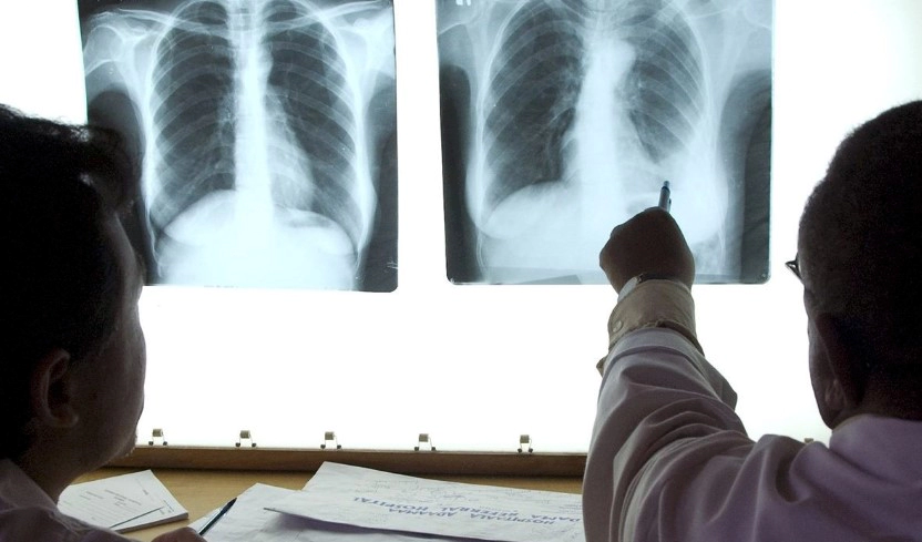 잠복결핵 양성 증상