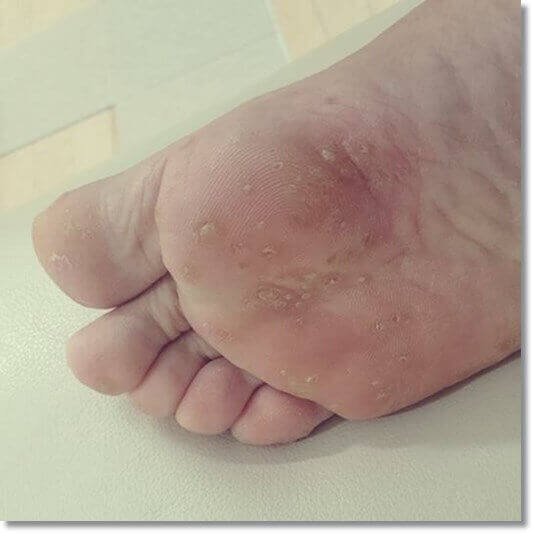 소와각질융해증 증상