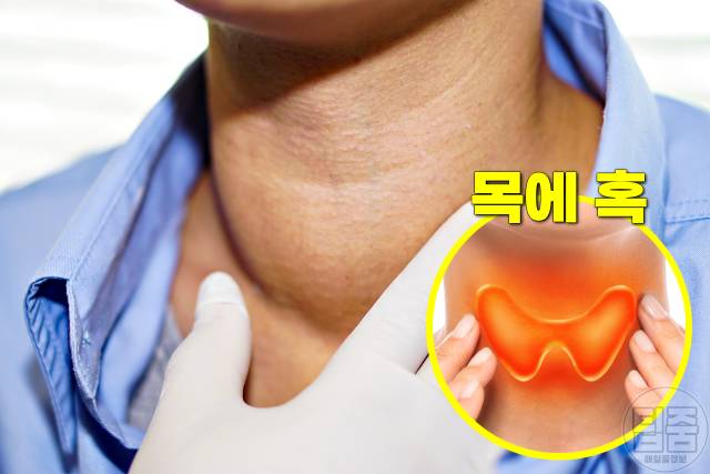 갑상선암 증상 목에혹 통증 갑상선암초기증상